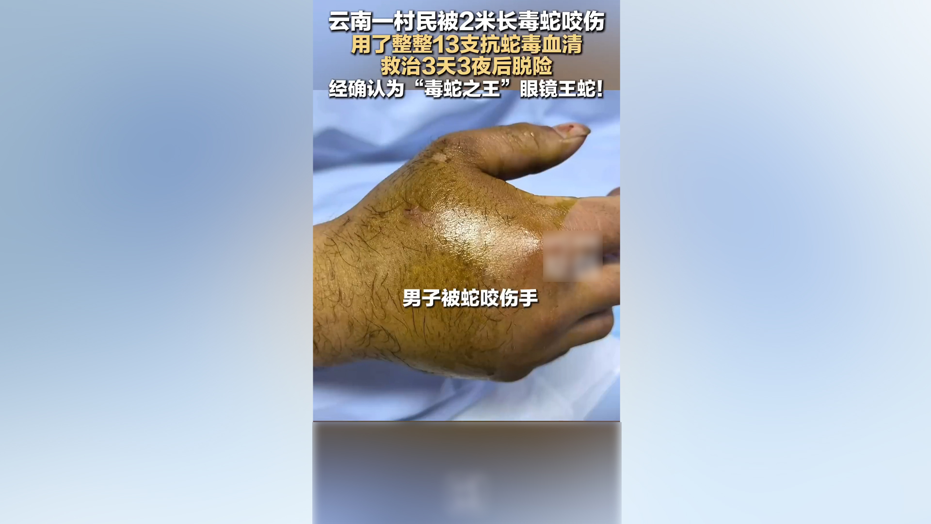 村民被眼镜王蛇咬伤打了13支抗蛇毒血清 救治3天3夜脱险