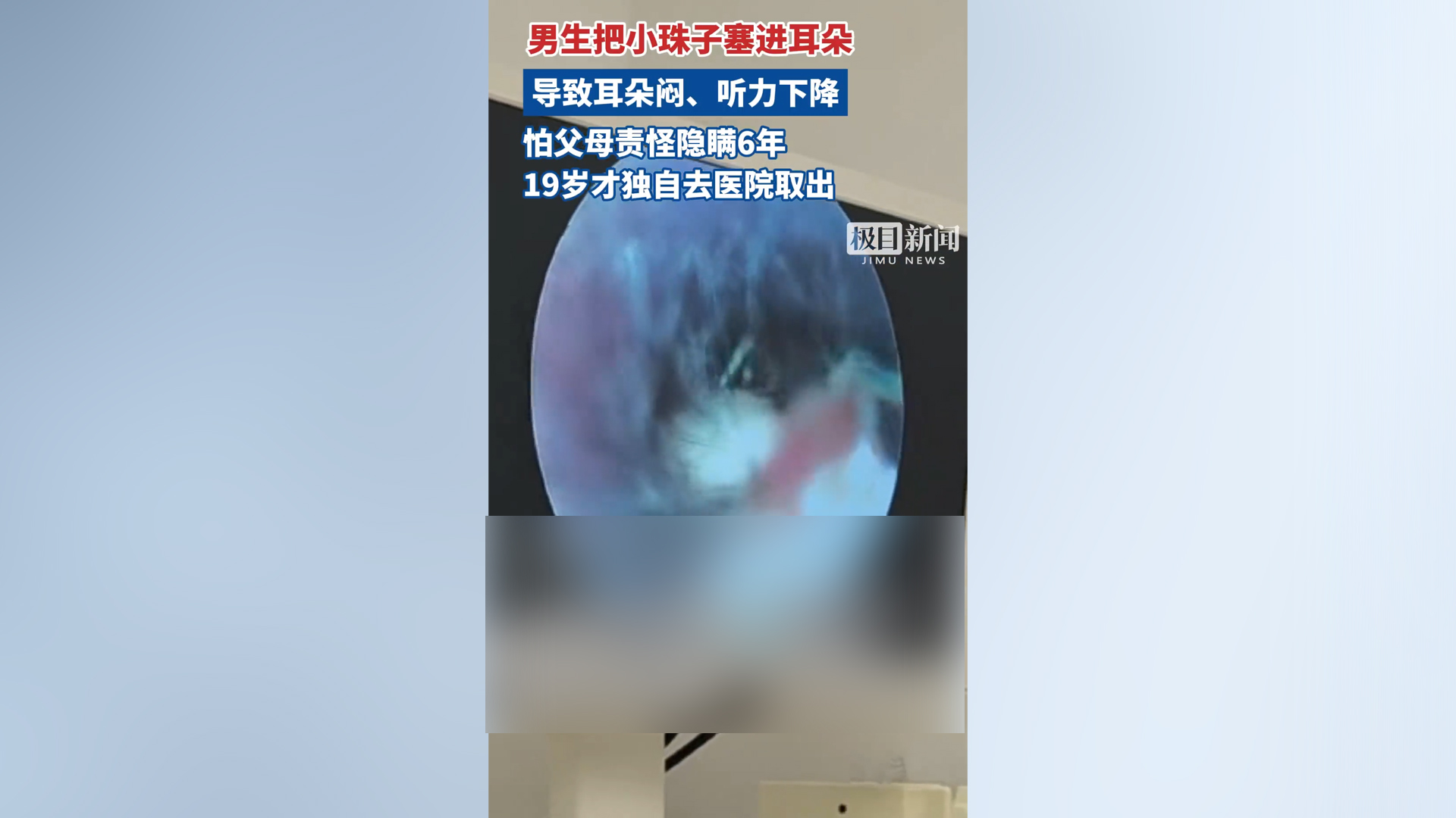 男孩把珠子塞进耳朵隐瞒6年 医生提醒家长关注：儿童是异物进耳高发人群